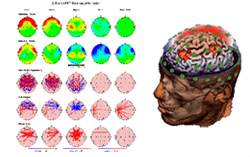 QEEG(Quantitative EEG) 정량적 뇌파 검사결과 사진